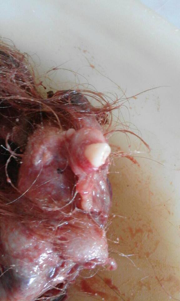 Жмутки волосся і зуби: українці вирізали пухлину з жахливою ''начинкою''. Фото 18+