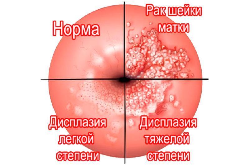 Почему папилломы и бородавки несут в себе скрытую угрозу для здоровья?