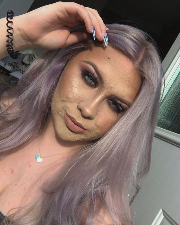 Страждаюча від прищів студентка позбулася комплексу і завела Instagram