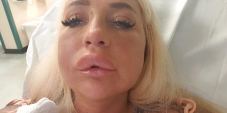 Порнозвезда сделала операцию по увеличению губ и чуть не умерла