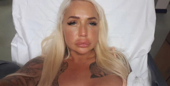 Порнозвезда сделала операцию по увеличению губ и чуть не умерла