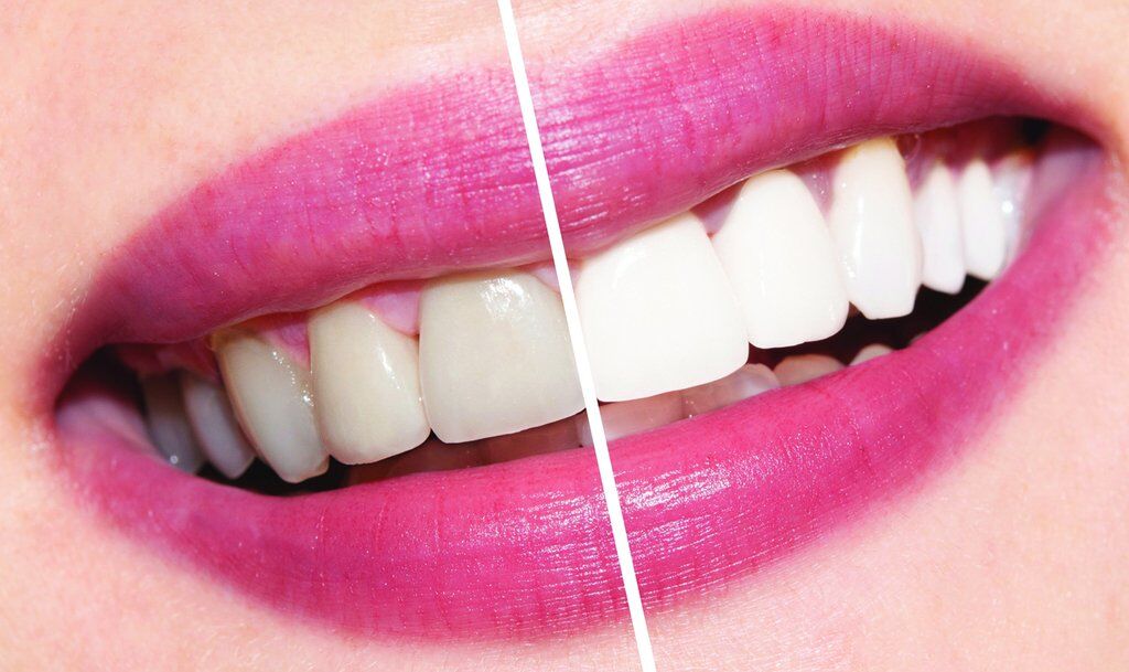 Совсем не смешно: как продукты для отбеливания зубов могут испортить вашу улыбку