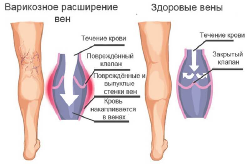 Варикозная болезнь: знай врага в лицо