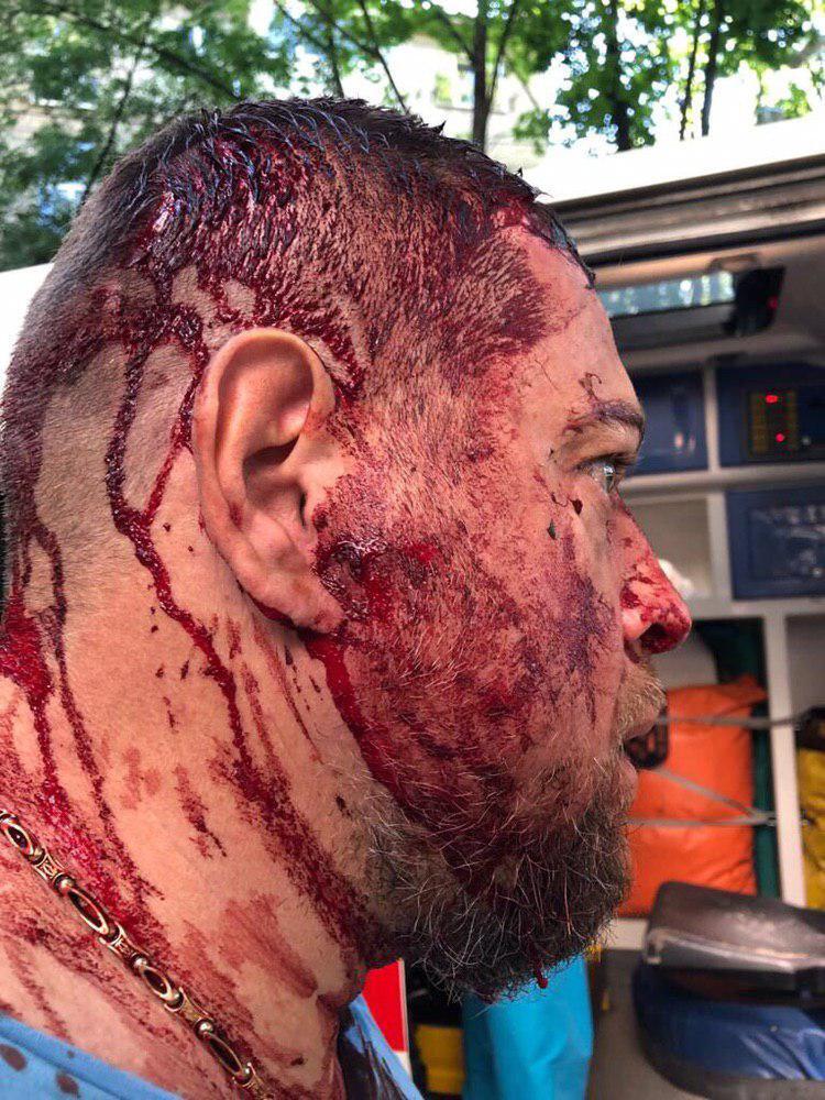 Били кастетами по голове: в Харькове совершено жестокое нападение на активиста