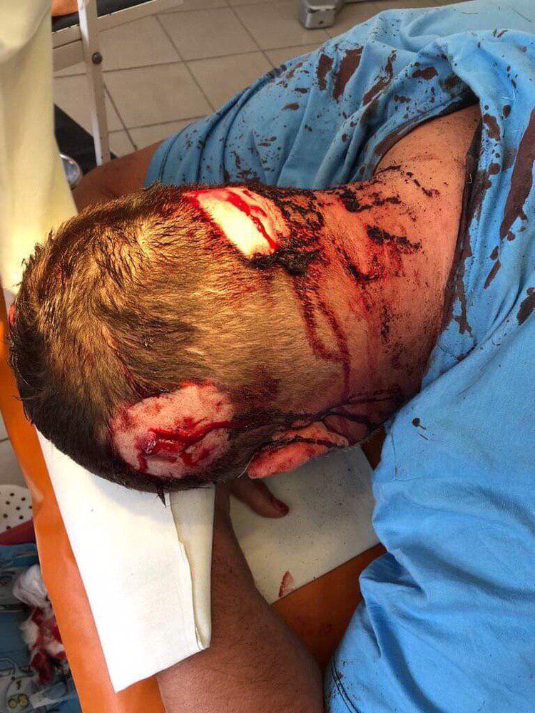 Били кастетами по голові: в Харкові скоєно жорстокий напад на активіста. Фото і відео 18+