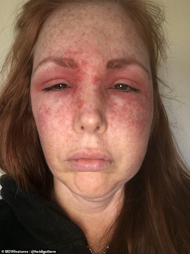 Женщина проснулась в ужасе: после нападения кошки ее лицо изменилось до неузнаваемости