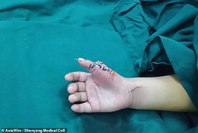 Було набагато більше 10: в Китаї дівчинці відрізали зайві пальці на руках. Моторошні фото