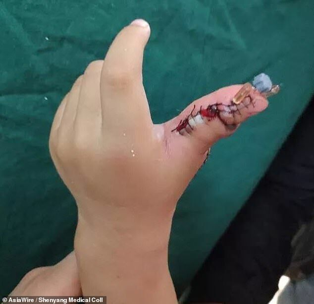 Було набагато більше 10: в Китаї дівчинці відрізали зайві пальці на руках. Моторошні фото