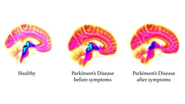 За 20 лет до симптомов: обнаружены признаки болезни Паркинсона