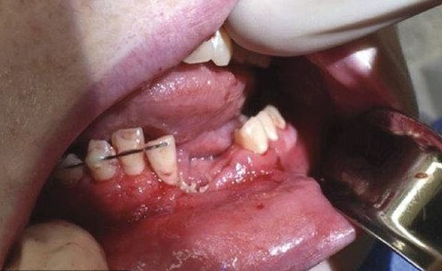 Сломанная челюсть, выбитые зубы: как вейп изуродовал подростка