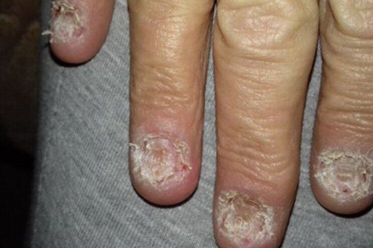 Захворювання нігтів