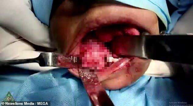 В Індії дитині видалили 526 зубів: страхітливий фоторепортаж