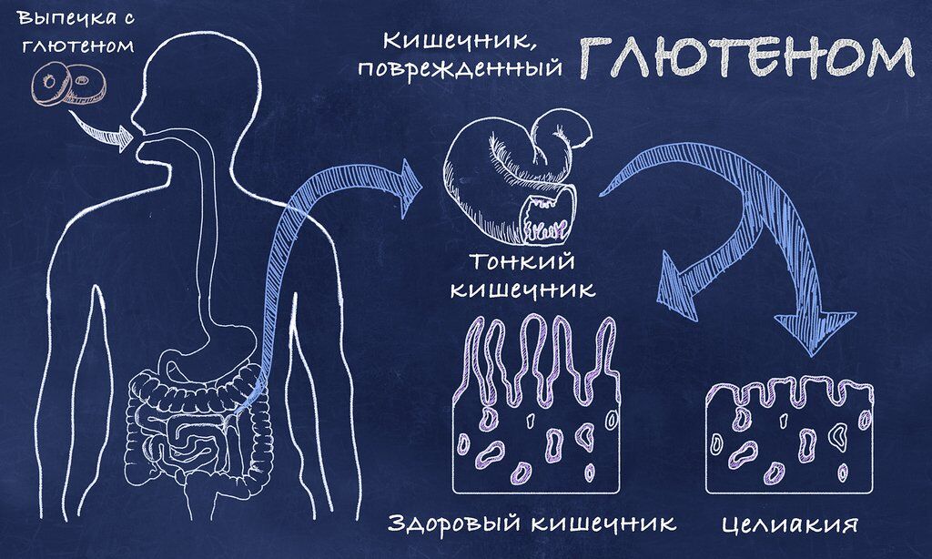 Інноваційний аналіз для діагностики целіакії