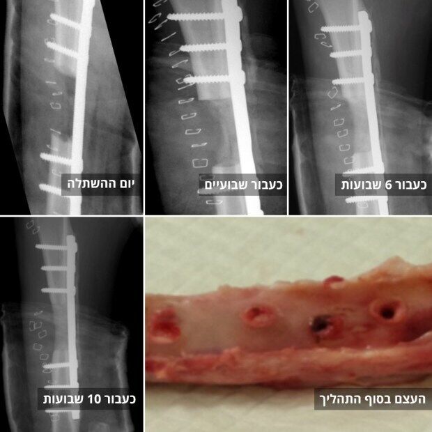 Рентгенівські знімки показують зростання кістки з жирових клітин. Зліва направо: в день пересадки, через 1, 6, 10 тижнів і в кінці процесу