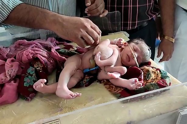 В Індії народилася дівчинка з 4 ногами і 3 руками