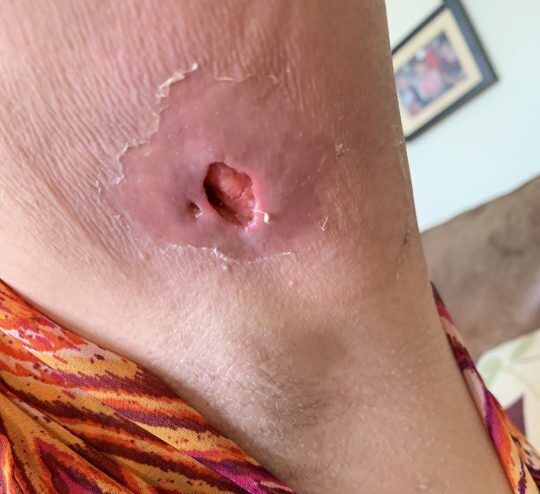 Дыра на руке пострадавшей от укуса паука женщины