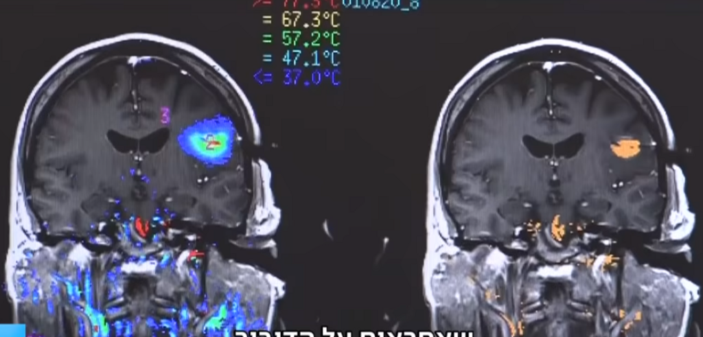 В Израиле ввпервые в мире удалили опухоль мозга лазером