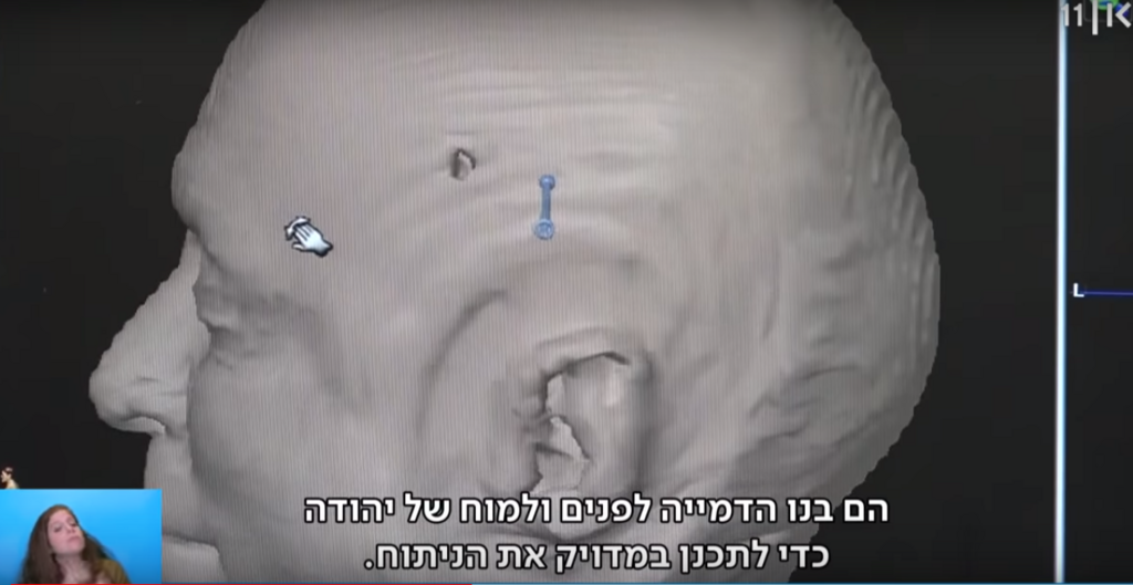 В Израиле впервые в мире удалили опухоль мозга лазером
