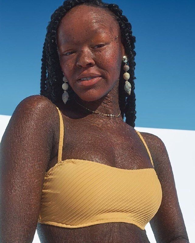 Луска замість шкіри: модель із рідкісним захворюванням знялася в рекламі купальників