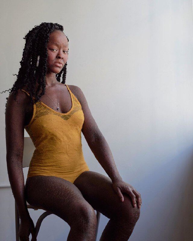 Чешуя вместо кожи: модель с редким заболеванием снялась в рекламе купальников