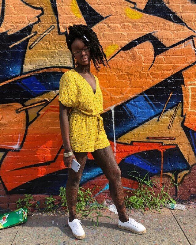 Чешуя вместо кожи: модель с редким заболеванием снялась в рекламе купальников