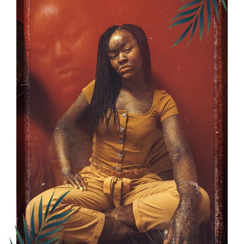 Чешуя вместо кожи: модель с редким заболеванием снялась в рекламе купальников