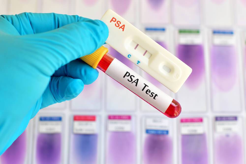 PSA – маркер диагностики и лечения рака простаты