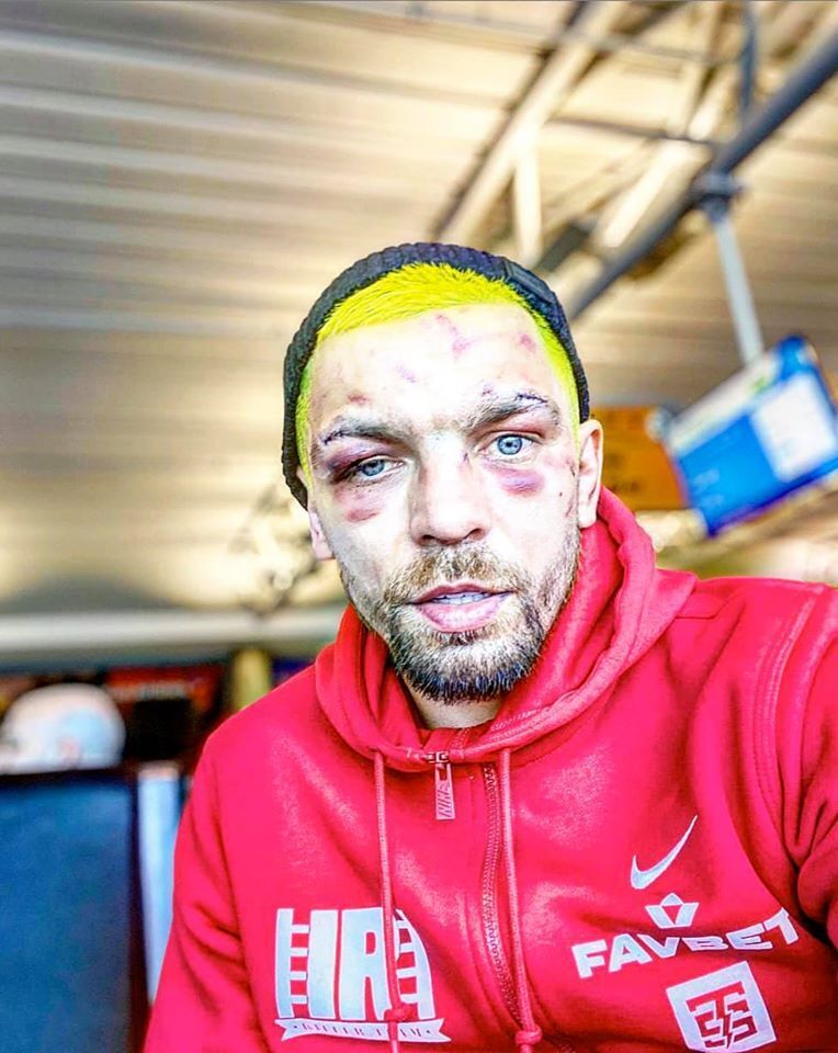 "Вот, черт!" Знаменитый украинский боксер показал лицо после боя (18+)