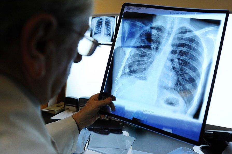 Туберкулез в Украине может стать проблемой №1