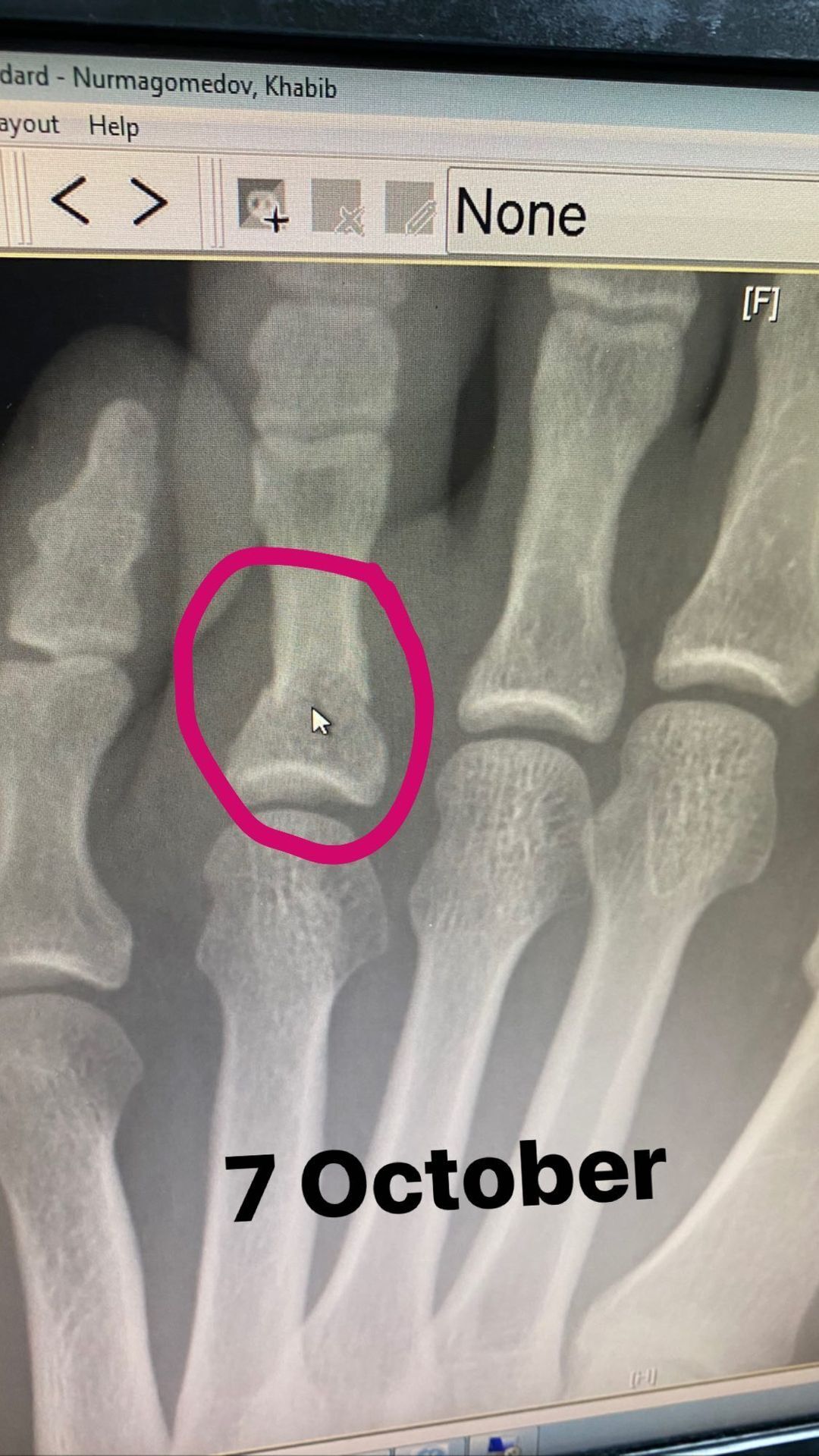 Хабіб показав рентген-знімок