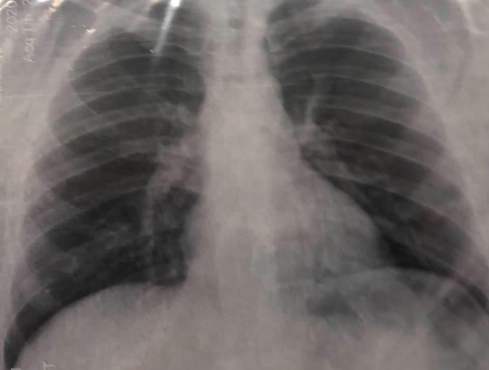 На рентгенівському знімку добре видно вже великі ділянки ураження легень коронавірусом