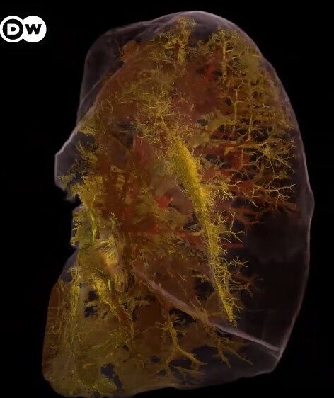 3D-модель пошкоджених коронавірусом легенів.