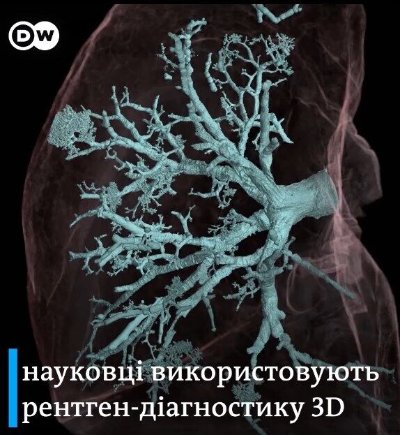 Як виглядають пошкоджені коронавірусом легені всередині.