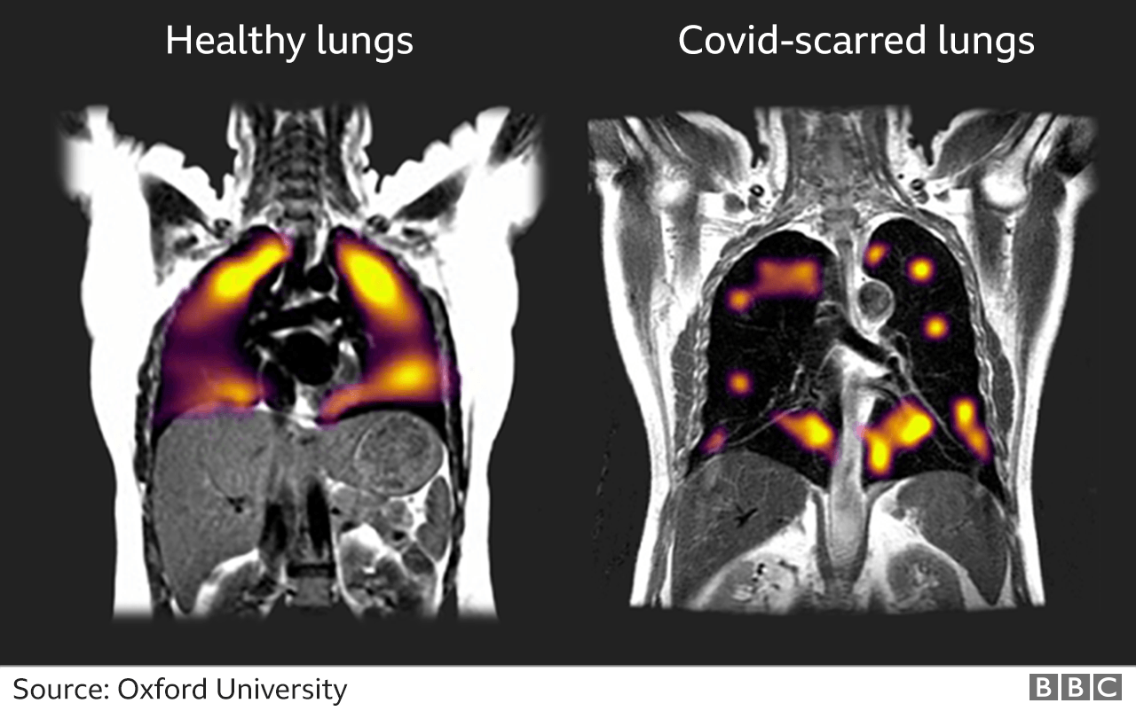 Темні ділянки – ті частини легенів, де повітря насилу транспортується в кров. Перший знімок – здорові легені, другий – пошкоджені коронавірусом