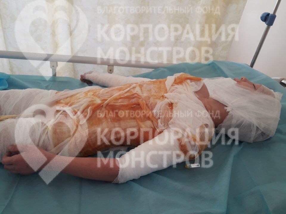 На Одесщине ребенок попал в больницу с жуткими ожогами