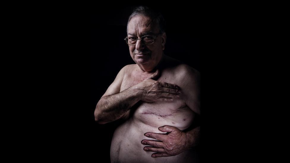 Піт Пассанісі виявив у себе рак грудей у 66 років