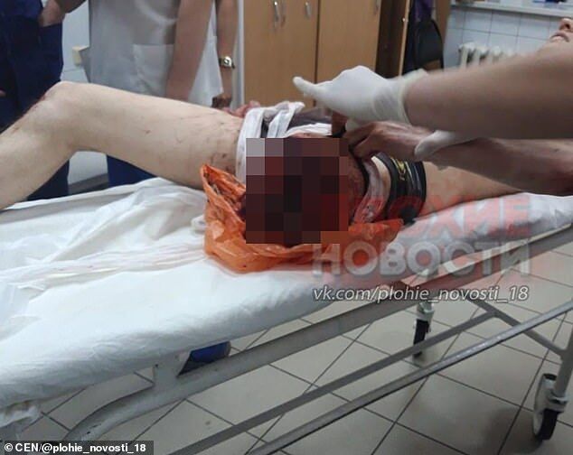 Росіянин у лікарні з відпиляною ногою