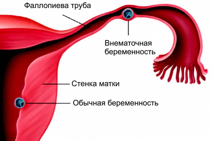 Внематочная беременность