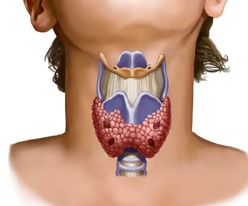 Щитовидна залоза: шість явних ознак того, що час до лікаря