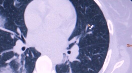 У нормальному стані легені виглядають, як на правій стороні знімка