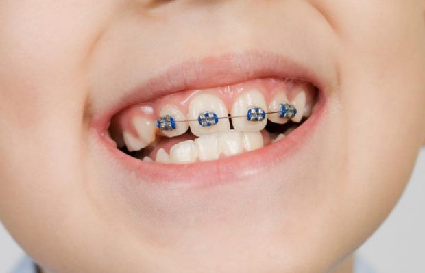 Чем опасен неправильный прикус: стоматологи раскрыли секреты