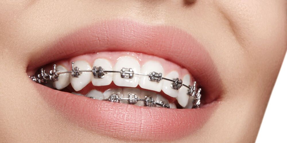 Чем опасен неправильный прикус: стоматологи раскрыли секреты