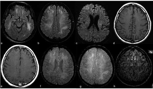 У 44% пацієнтів з COVID-19 МРТ показало аномалії головного мозку