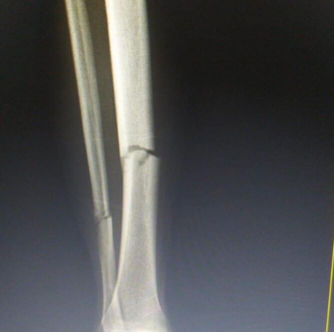 Рентгеновский снимок ноги Фернандо Муслера