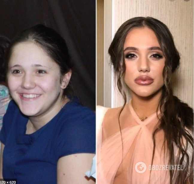 Даша Ульянова до і після збільшення губ