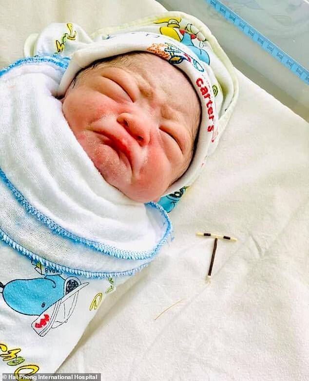 Младенец родился с контрацептивом (фото: Hai Phond International Hospital)