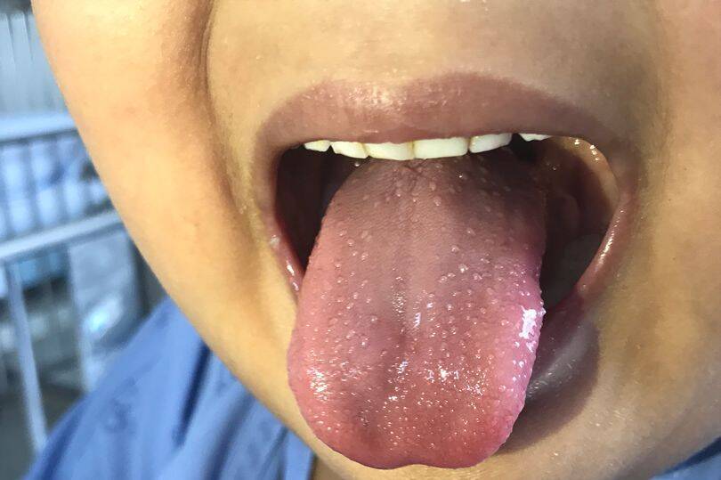 Хвороба Кавасакі може викликати подразнення на язику