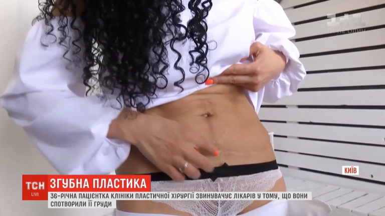 В Полтаве пластические хирурги "искромсали" двух женщин: клиентки хотели увеличить грудь
