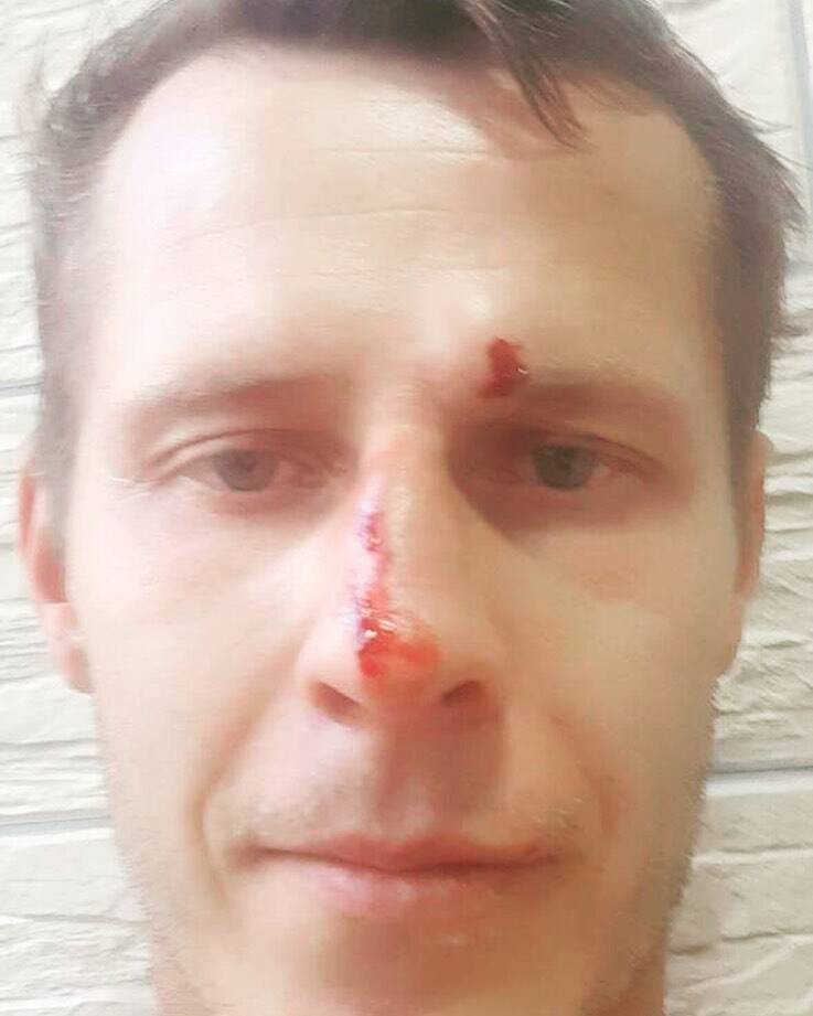 Олександр Денисов показав, як виглядає арбітр після побиття в матчі Першої ліги