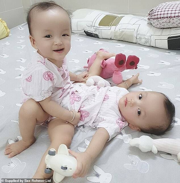 Во Вьетнаме успешно разделили близняшек, сросшихся в бедре.